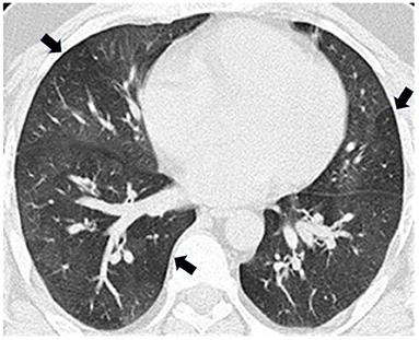 Case Report: Flavoring-Related Lung Disease in a Coffee Roasting and Packaging Facility Worker With Unique Lung Histopathology Compared With Previously Described Cases of Obliterative Bronchiolitis